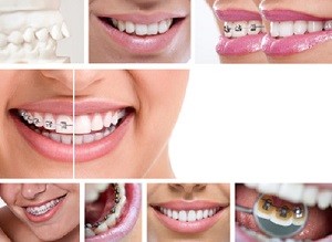 Ratgeber feste Zahnspange - sauber durch elektrische Zahnbürste Elektrische Zahnbürste Test und Testsieger die besten elektrischen Zahnbürsten kaufen Test von elektrischen Zahnbürsten 2017 Braun Oral B Elektrozahnbürsten