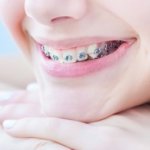 Zahnspange notwendig - Zahnspangen Kosten für Erwachsene