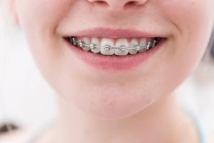Zahnspange Kosten - Zahnspangen herausnehmbar und fest