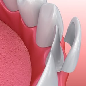 Veneers - Verblendschalen für die weiße Zähne