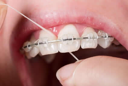 professionelle Zahnreinigung mit Zahnseide und Polierstreifen