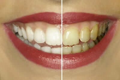 professionelle Zahnreinigung - weiße Zähne - saubere Zähne