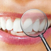 gesunde zähne - Professionelle Zahnreinigung - Gingivitis Ursachen und Hilfe