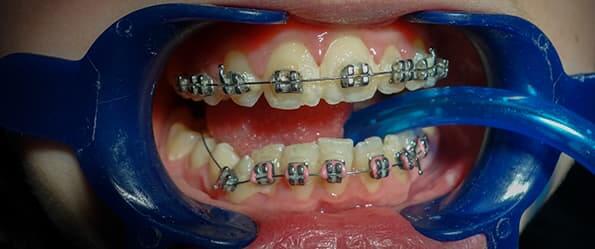 Zahnbelag und Zahnfleischentzündung bei fester Zahnspange