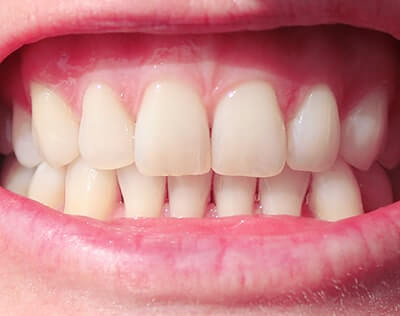 Diamond Smile Home Bleaching - Ergebnis der Zahnaufhellung