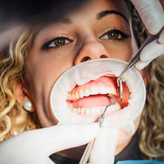 Zahnreinigung vor der Zahnaufhellung