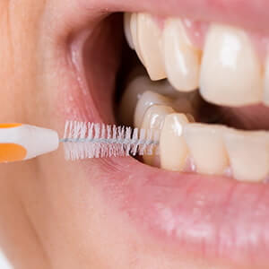 Interdentalbürste, Zahnzwischenraumbürste Anwendung für die Zahnzwischenraumreinigung