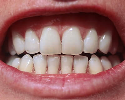 Wondersmile Erfahrungen - vorher nachher Bilder