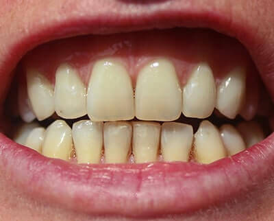 Wondersmile Homebleaching - Zähne aufhellen zuhause