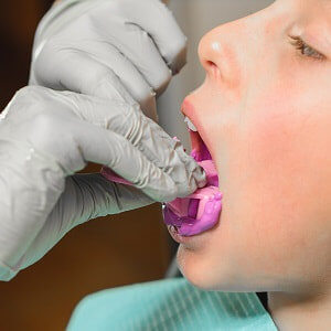 Zahnabdrücke ohne Würgereiz - Gebiss Abdrücke beim Zahnarzt