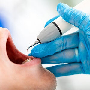 Ultraschall Zahnstienenferner Test - Zahnsteinentfernung elektrisch
