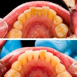 Zahnstein selbst entfernen und vorbeugen