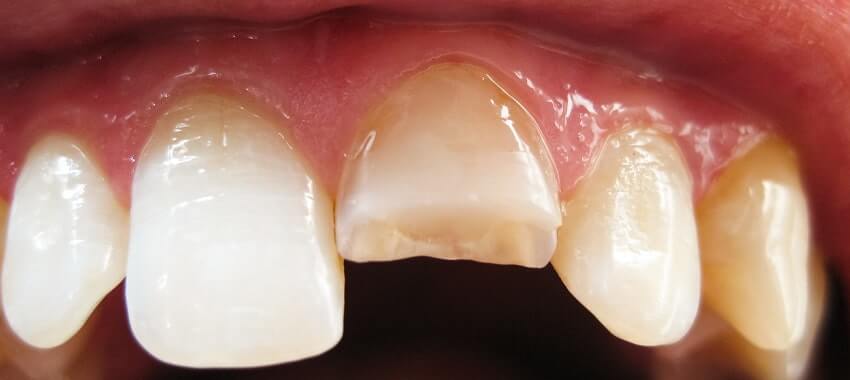 Zahn abgebrochen oder gesplittert - gebrochene Zähne