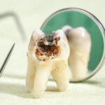 Fauler Zahn - Karies, verfaulte Zähne