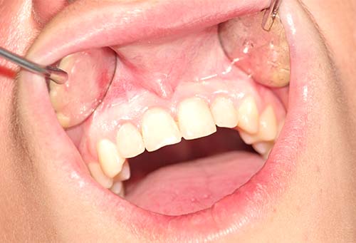 Verfaulte Zähne nach der Behandlung mit Kunststoff Füllungen