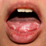 Zungenpilz - Mundsoor - Candida