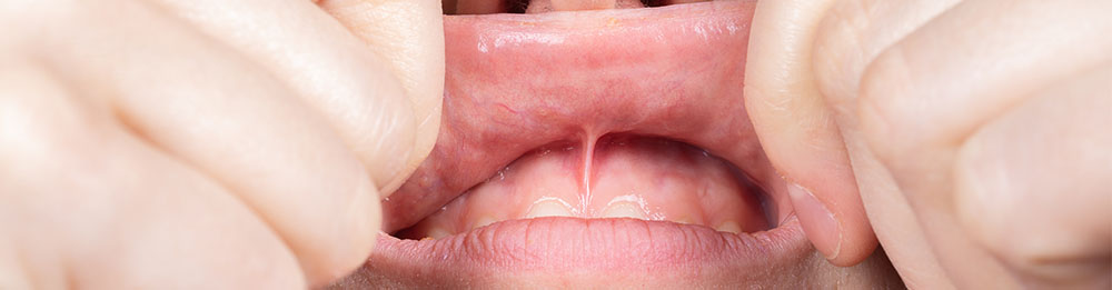 Lippenbändchen entfernen - frenulum labii im Oberkiefer