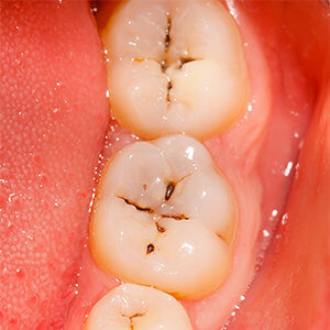 Loch im Zahn - ist das Karies in den Zähnen