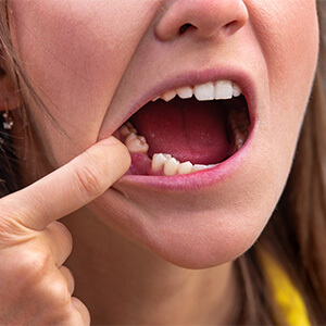 Zahnlücke - Lücke zwischen den Zähnen